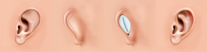 돌출귀 Prominent Ear